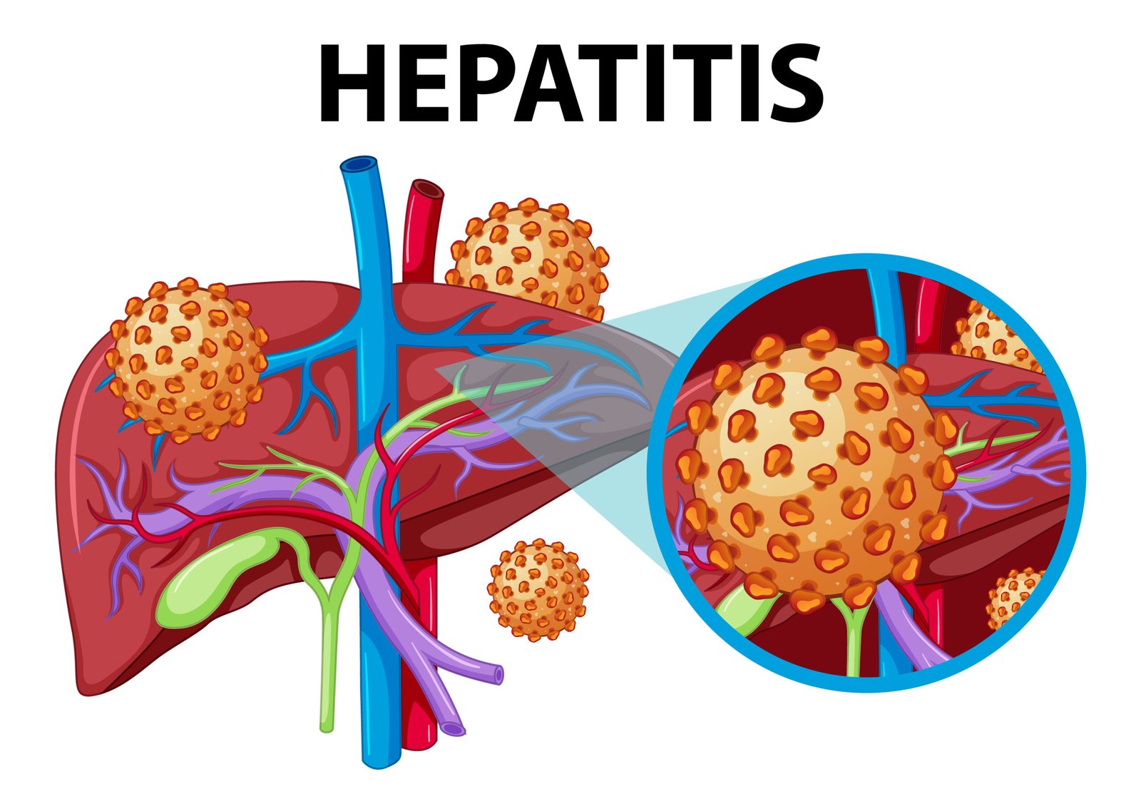 What is hepatitis